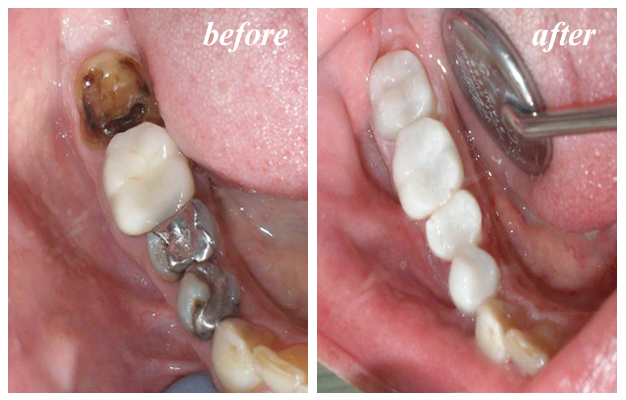 CEREC Chairside Restoration of Esthetic Ceramics